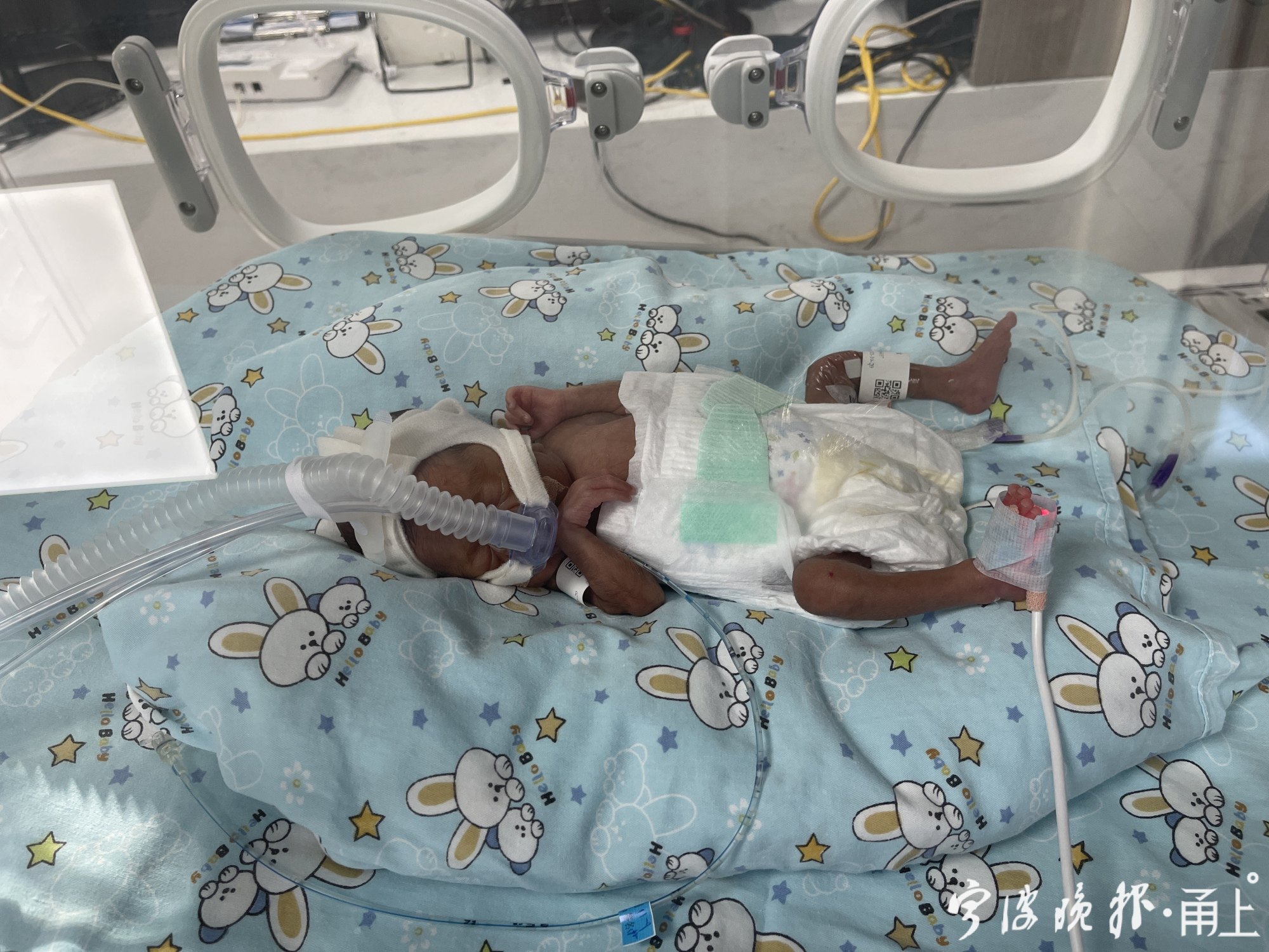 宁波这个早产宝宝出生体重仅580克身长比成人的巴掌还